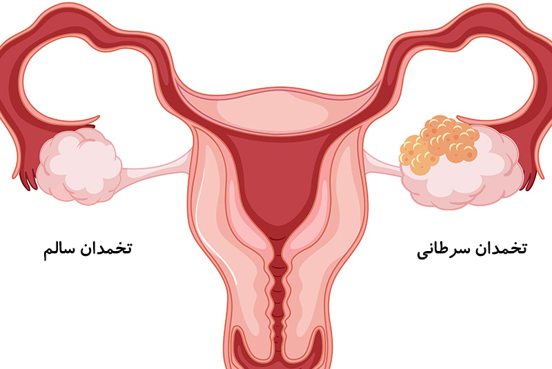 گلاب برای مشکلات رحم